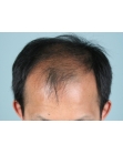 Before Hair Transplant&nbsp;2 Sessions (Areas)